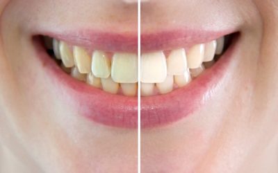 SBIANCAMENTO DENTALE