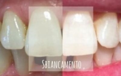 SBIANCAMENTO DENTALE IN POLTRONA (in office)