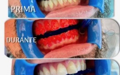 SBIANCAMENTO POST IGIENE DENTALE BLANCONE CLICK